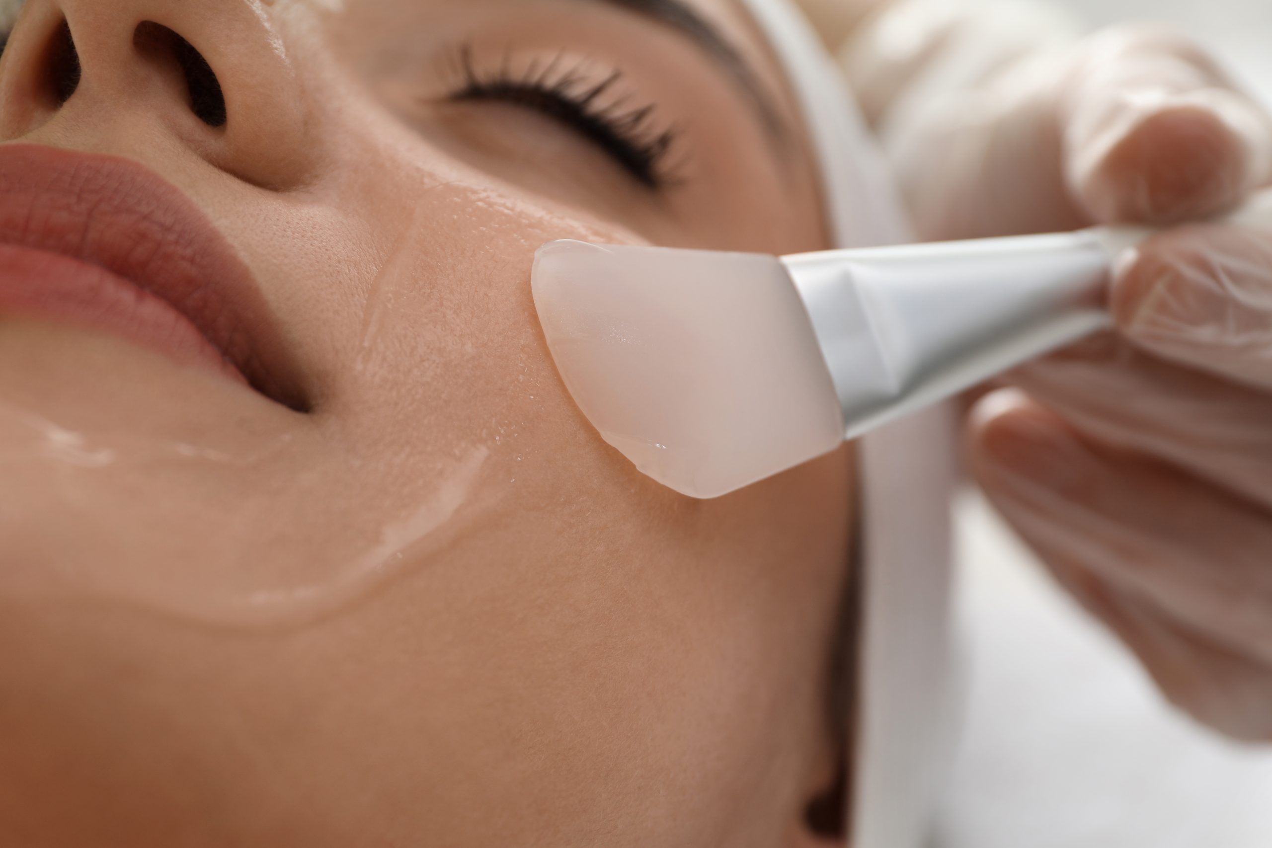 Chemical peeling on a woman's face